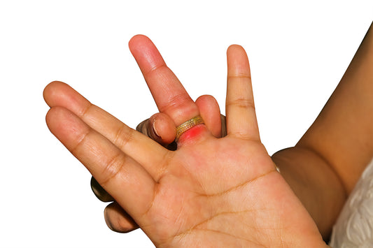 5 Steps on How To Remove Rings From Swollen Fingers